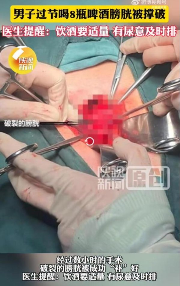 广瑞网 男子豪饮8瓶啤酒膀胱被撑破 饮酒需适量